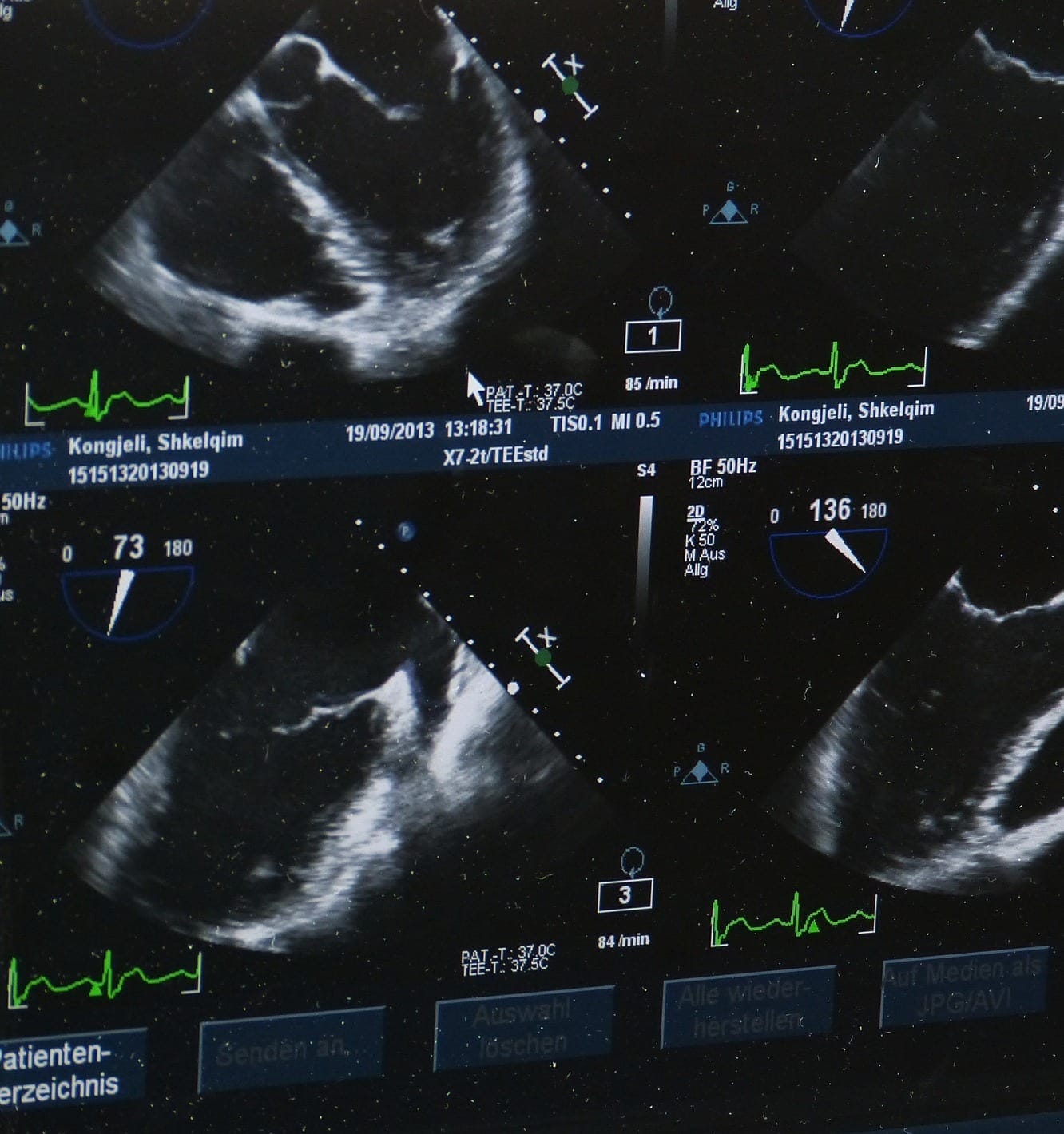 Wrongful Birth - Child Born with Undiagnosed Defects During Pregnancy