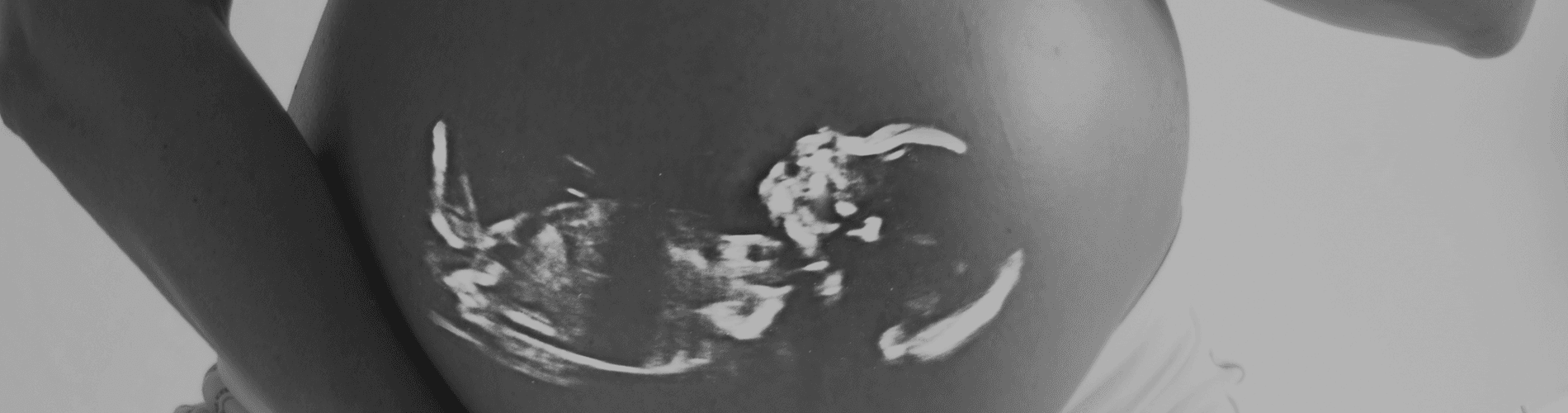 Medical Malpractice in the Treatment of Premature Babies